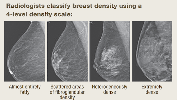 Breast Density Exam | University Radiology Of NJ